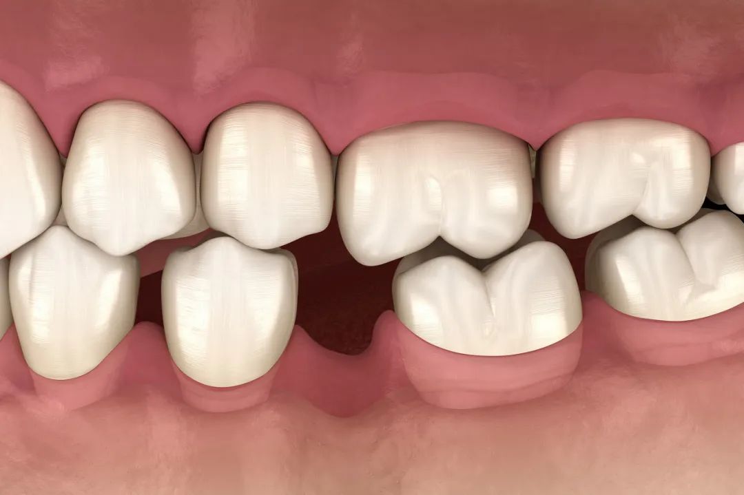 缺牙后邻牙是怎么歪的？两边的牙歪了还能种牙吗？