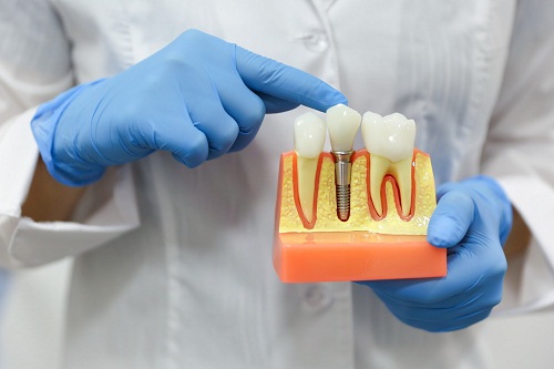 剝牙後幾耐可以進行種牙?深圳種牙能用香港長者醫療券嗎?