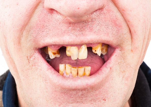 请问深圳爱康健口腔长时间缺牙的人容易衰老吗?